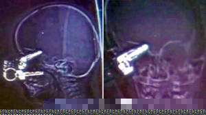 Рентгеновский снимок со связкой ключей в голове мальчика