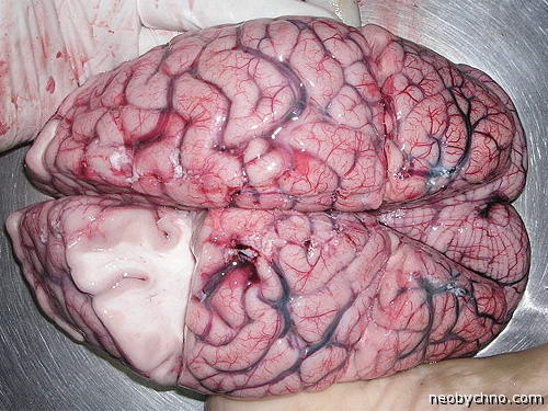 Трансплантация мозга